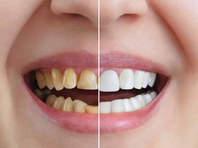 Top 10 Benefits of Dental Crowns
